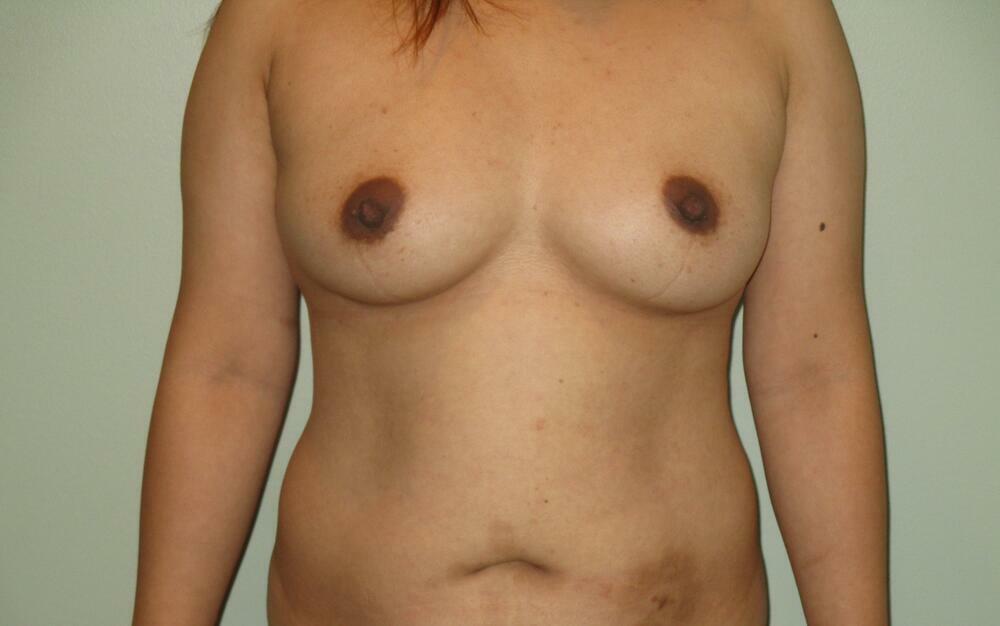 Breast Augmentation with Lift Before & After